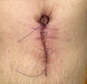 After Image: Umbilicoplasty