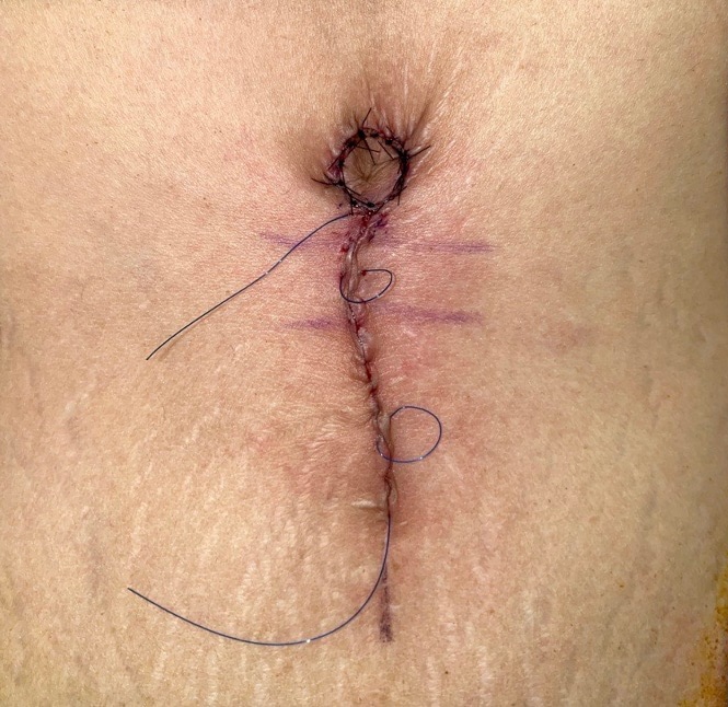 After Image: Umbilicoplasty - front
