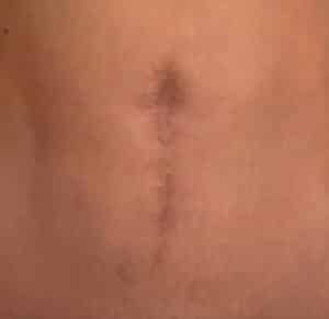 Before Image: Umbilicoplasty