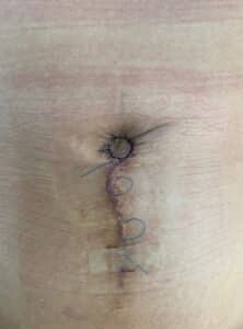 After Image: Umbilicoplasty