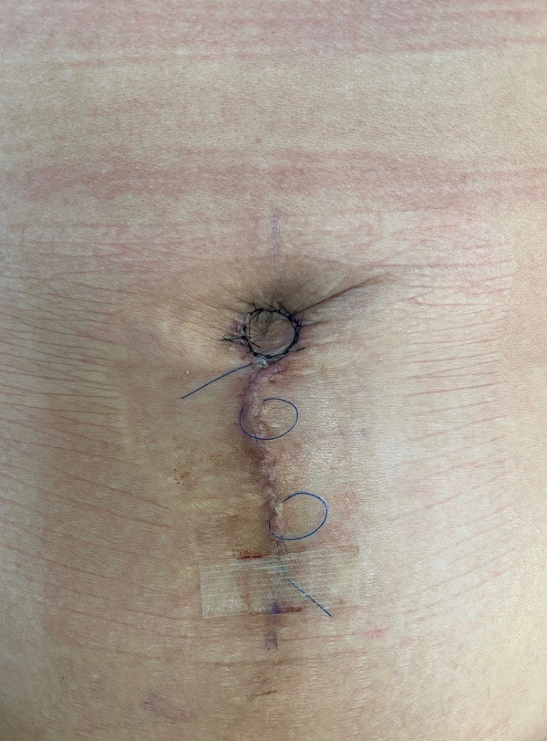 After Image: Umbilicoplasty - front