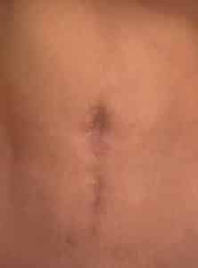 Before Image: Umbilicoplasty