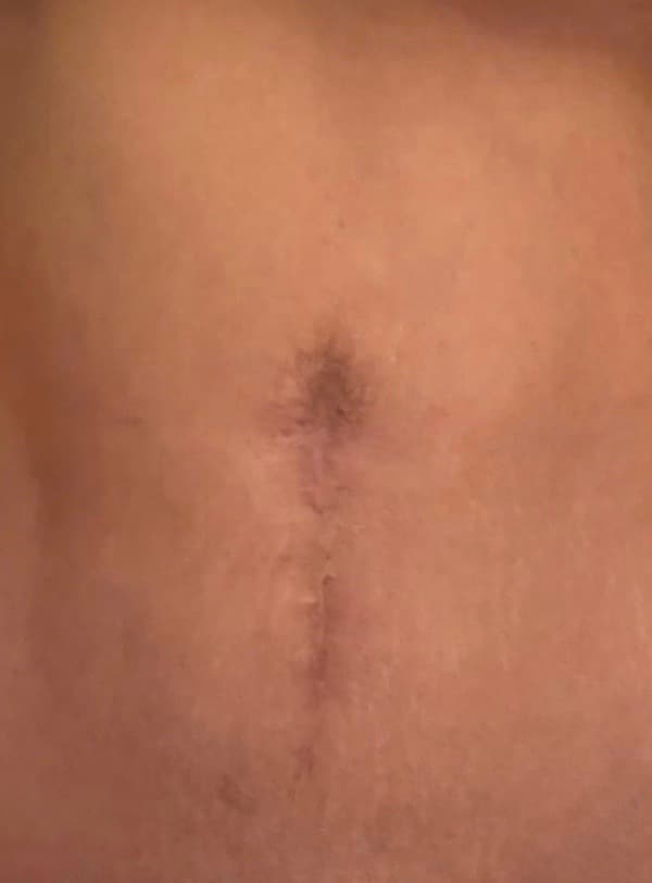 Before Image: Umbilicoplasty - front