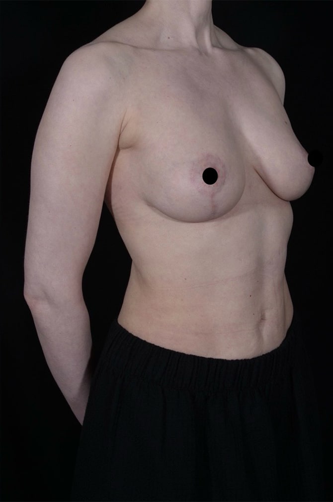 After Image: Liposuction - right-front-oblique
