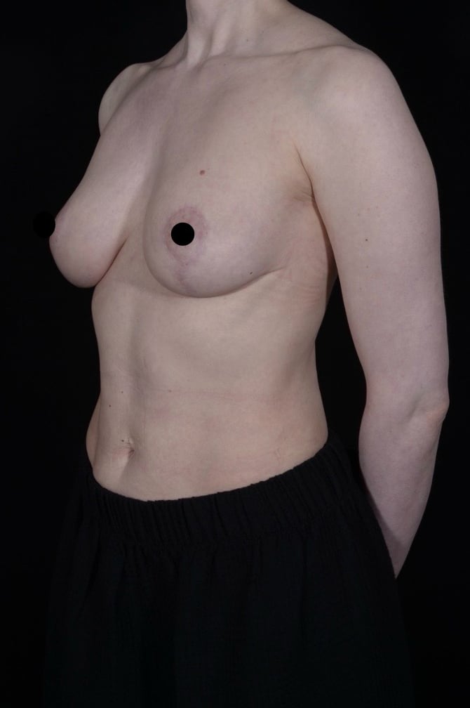 After Image: Liposuction - left-front-oblique