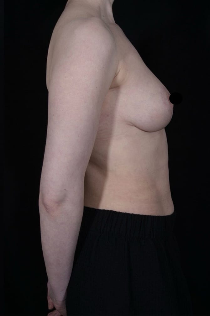 After Image: Liposuction - right-side