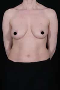 Before Image: Breast Lift
