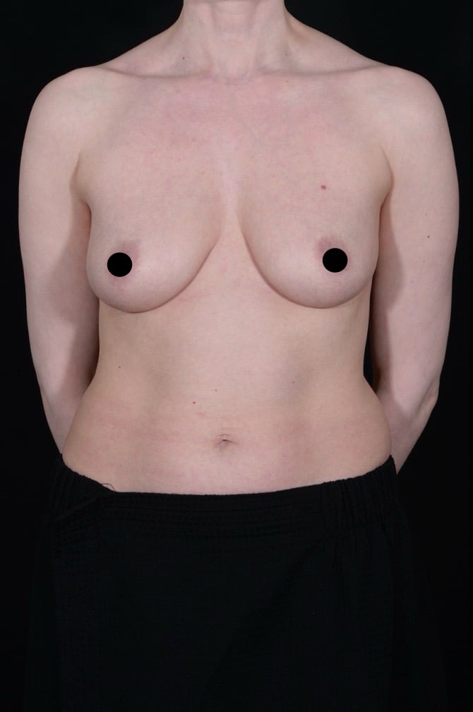 Before Image: Liposuction - front
