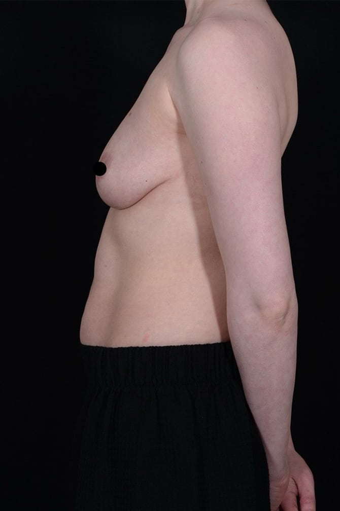 Before Image: Liposuction - left-side