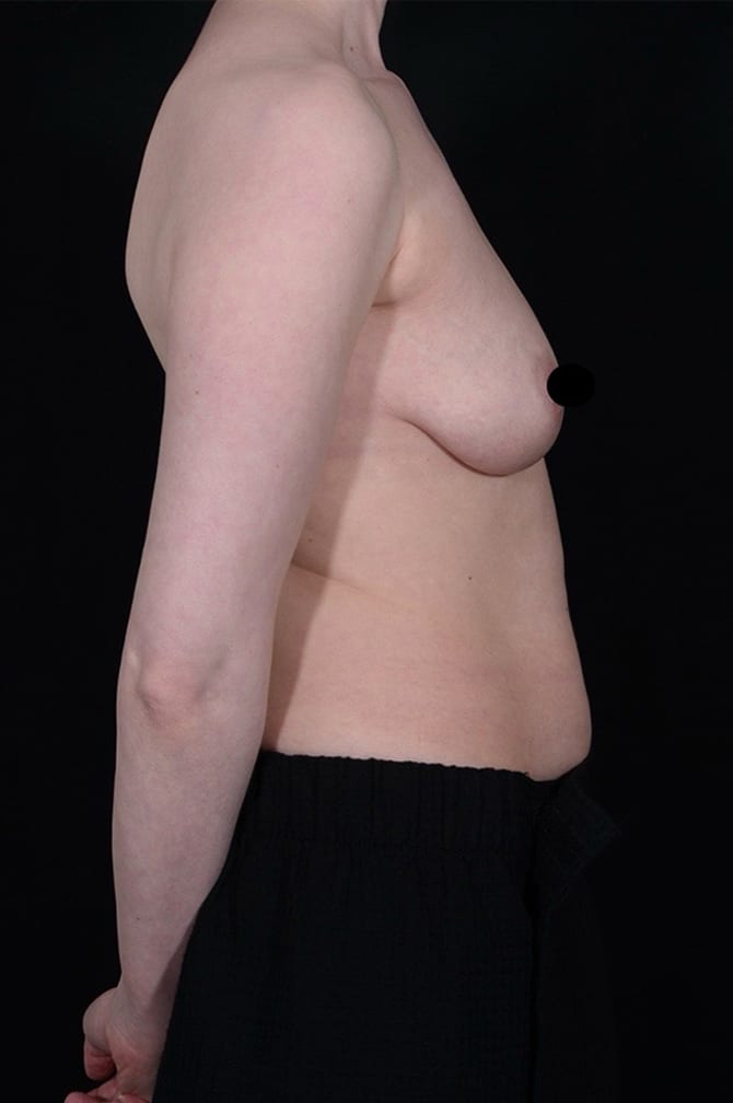 Before Image: Liposuction - right-side