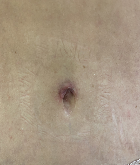 After Image: Umbilicoplasty - front