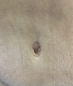 Before Image: Umbilicoplasty
