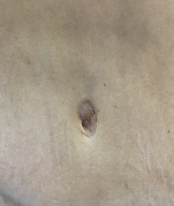 Before Image: Umbilicoplasty - front