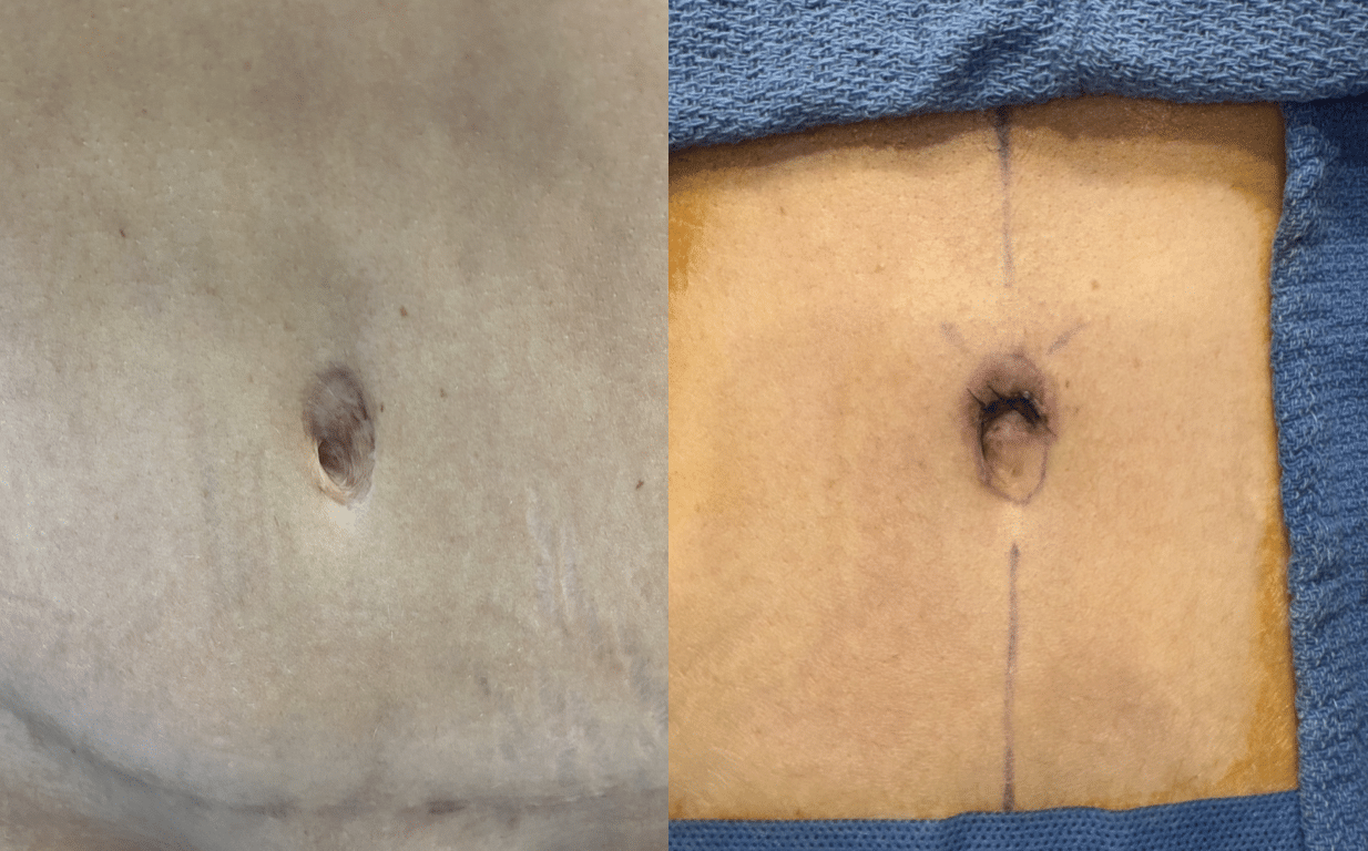 Postoperative image immediately post-procedure