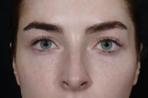 After Image: Blepharoplasty
