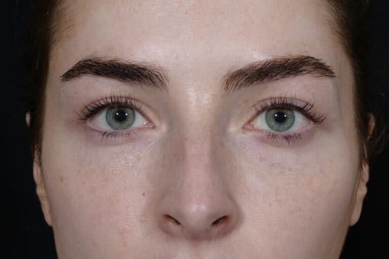 After Image: Blepharoplasty - front