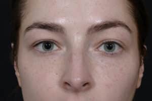 Before Image: Blepharoplasty