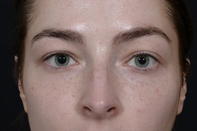 Before Image: Blepharoplasty - front