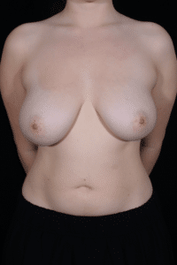 Before Image: Breast Reduction