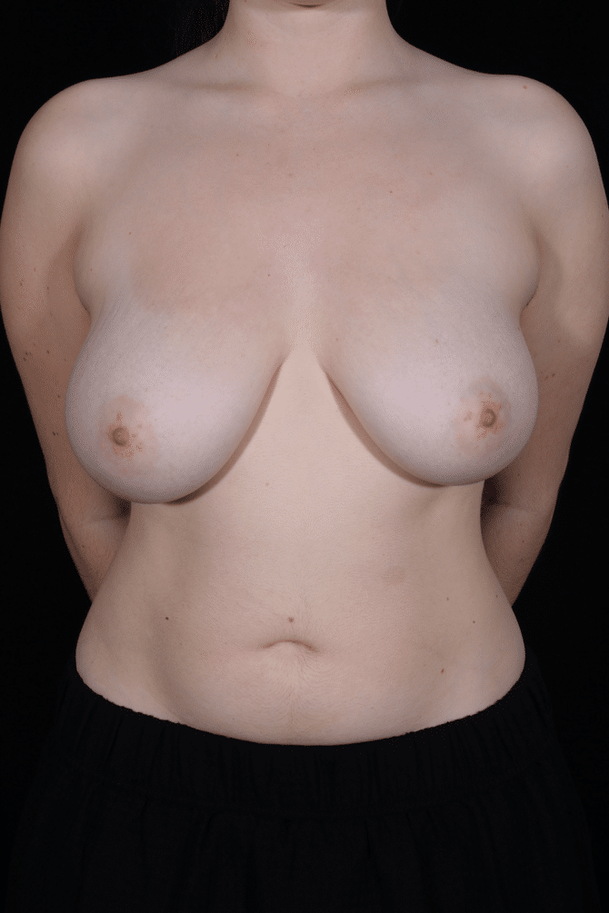 Before Image: Breast Reduction - front