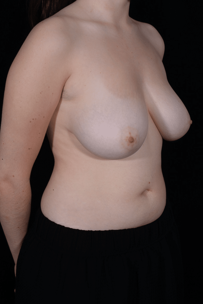 Before Image: Breast Reduction - right-front-oblique