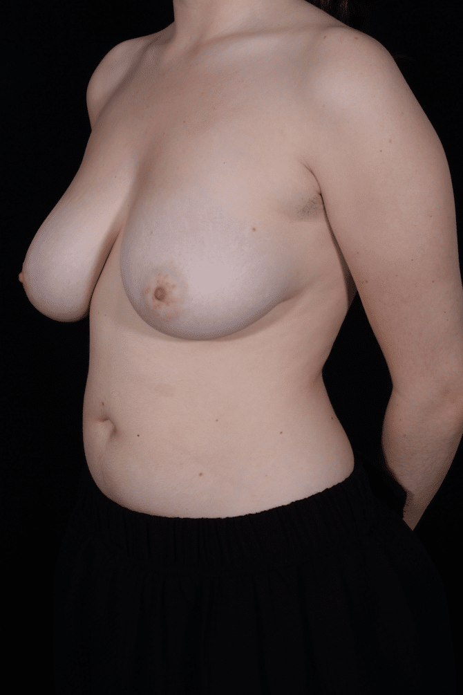Before Image: Breast Reduction - left-front-oblique