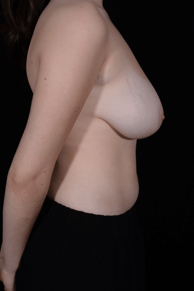 Before Image: Breast Reduction - right-side