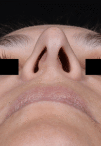 Before Image: Rhinoplasty