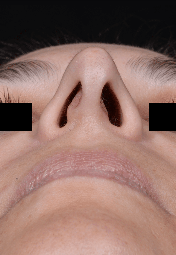 Before Image: Rhinoplasty - front