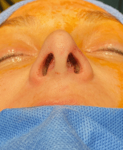 After Image: Rhinoplasty