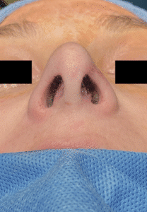 After Image: Rhinoplasty