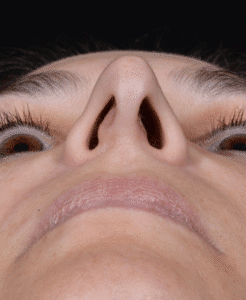 Before Image: Rhinoplasty
