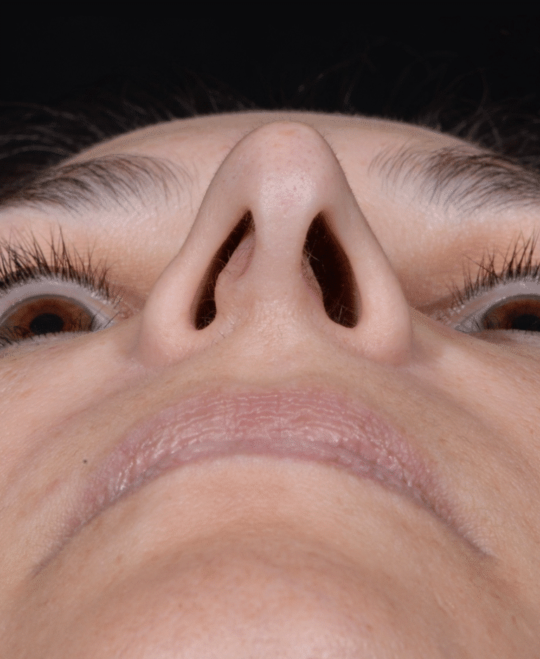 Before Image: Rhinoplasty - front