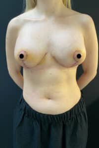 After Image: Breast Revision