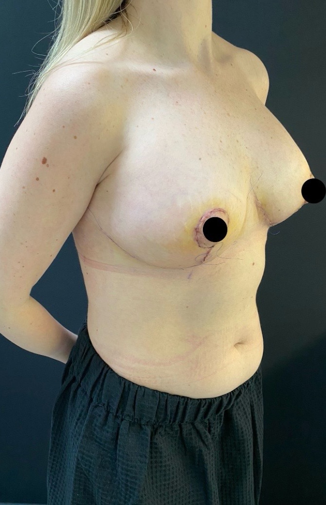 After Image: Breast Revision - right-front-oblique