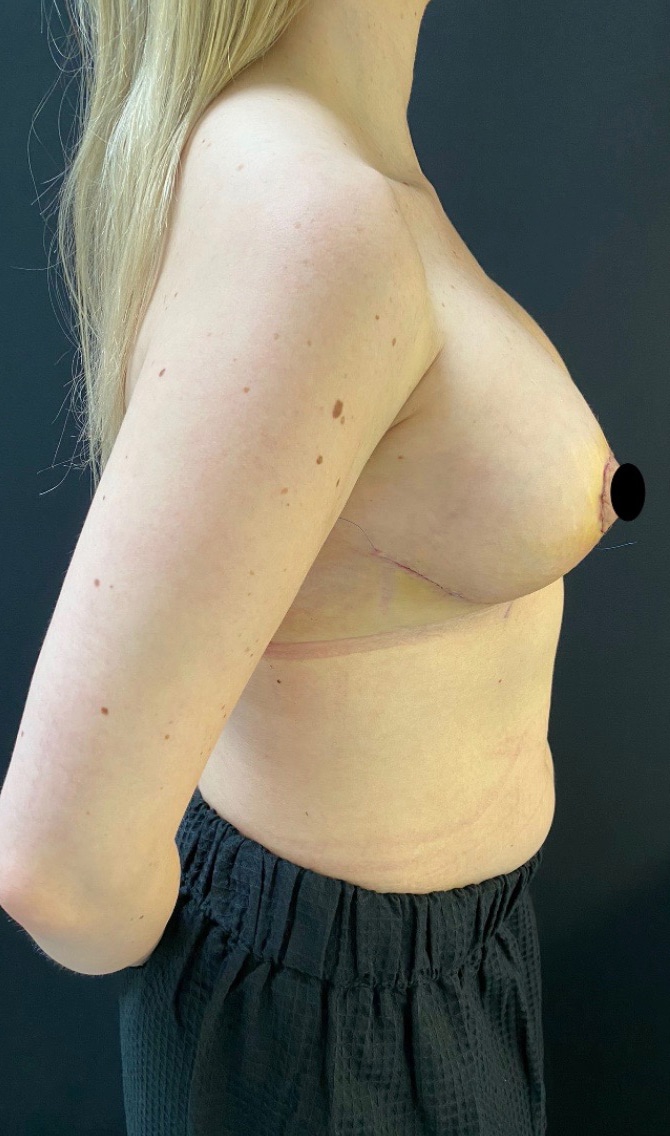 After Image: Breast Revision - right-side