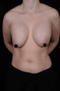 Before Image: Breast Revision