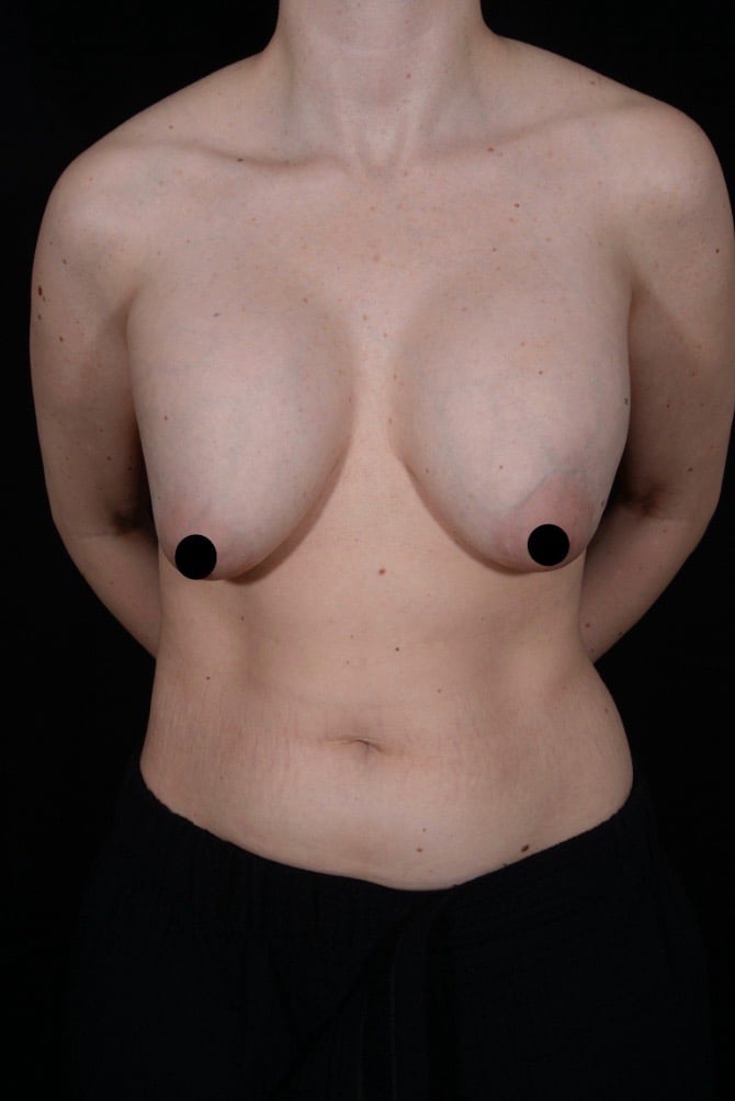 Before Image: Breast Revision - front