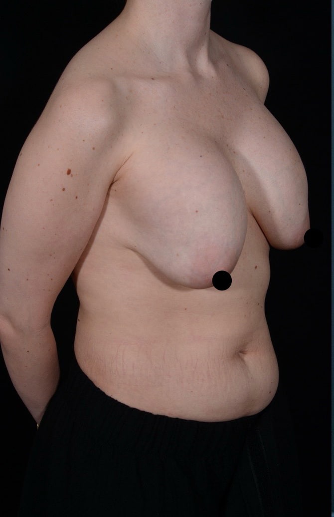 Before Image: Breast Revision - right-front-oblique