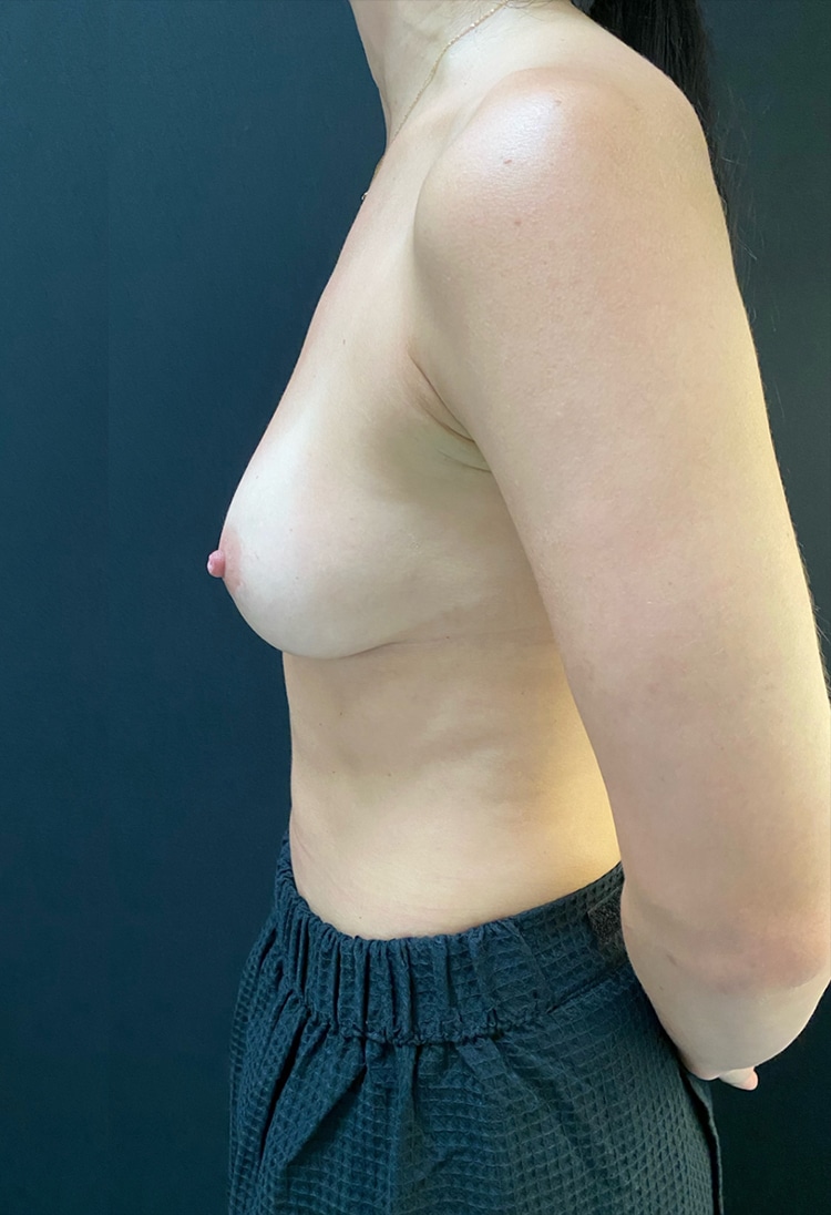 After Image: Breast Augmentation - left-side