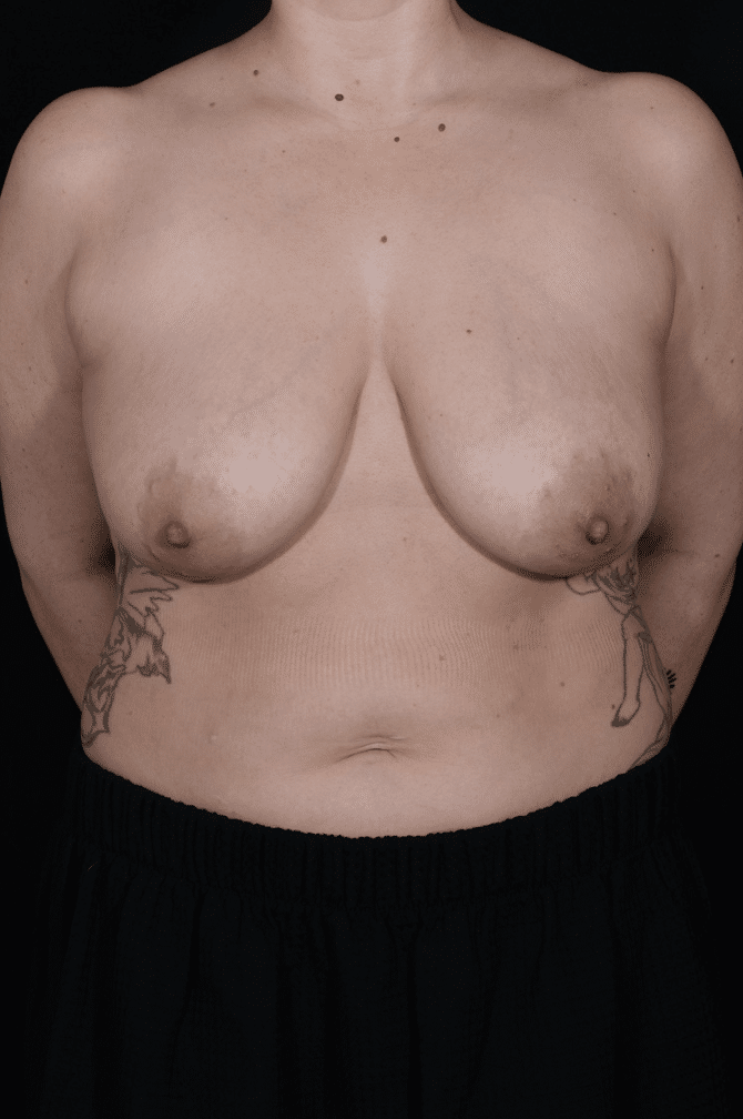 Before Image: Breast Reduction - front