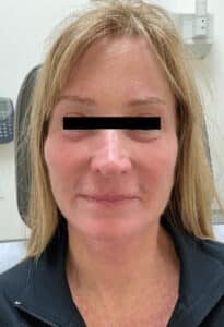 After Image: Facelift