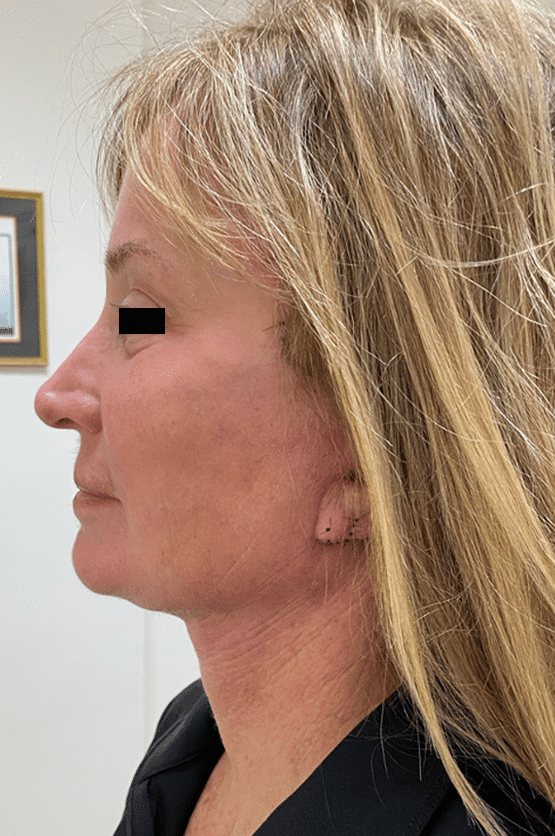 After Image: Facelift - left-side