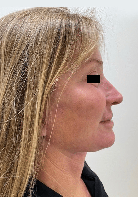After Image: Facelift - right-side