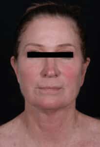 Before Image: Facelift