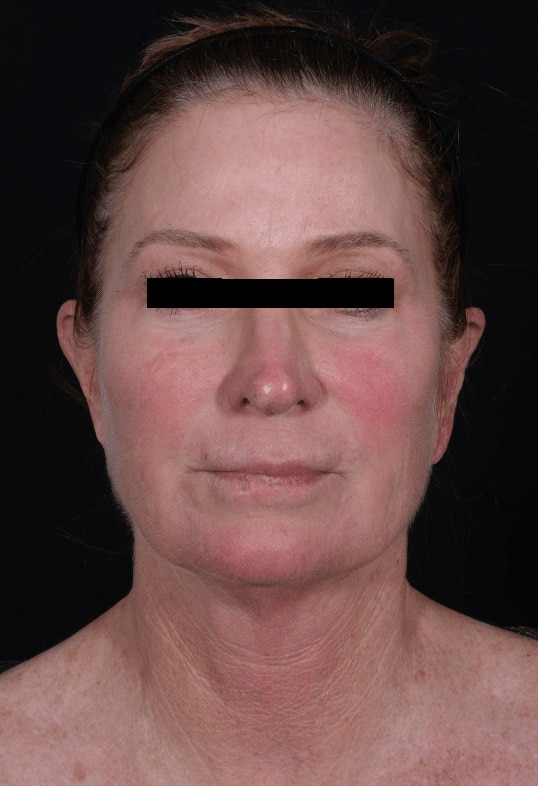 Before Image: Facelift - front