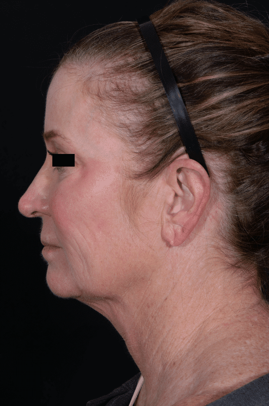 Before Image: Facelift - left-side