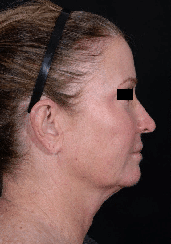 Before Image: Facelift - right-side