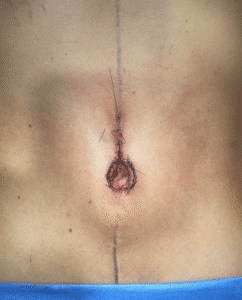 After Image: Umbilicoplasty