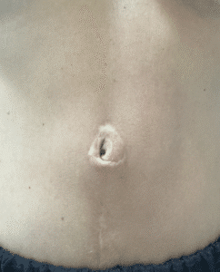 Before Image: Umbilicoplasty